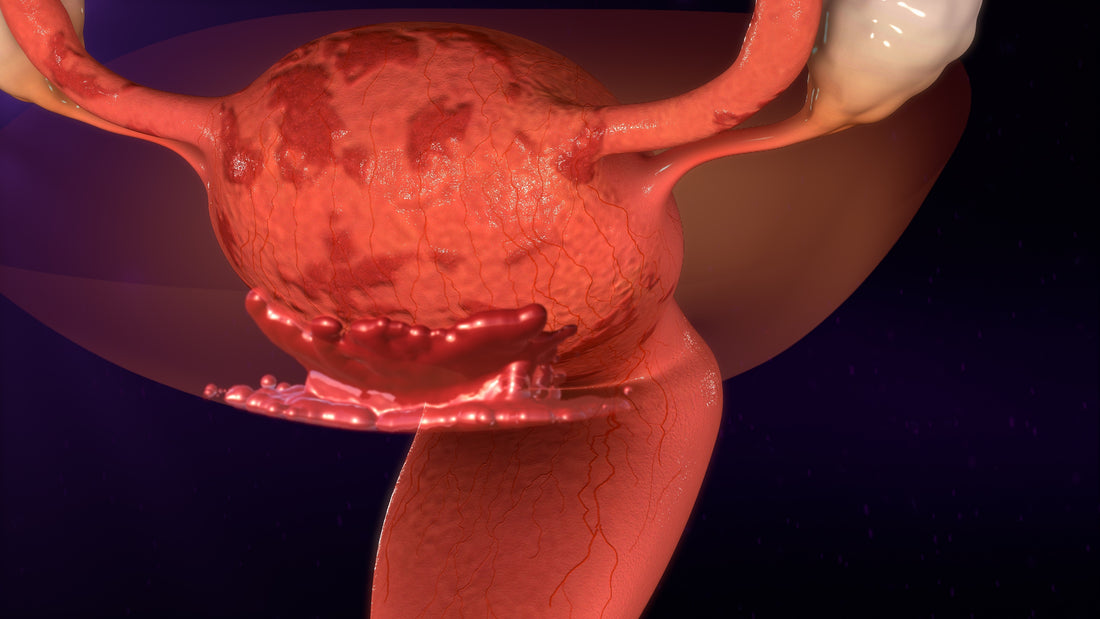 Endometriosis: Addressing the Underlying Causes Naturally